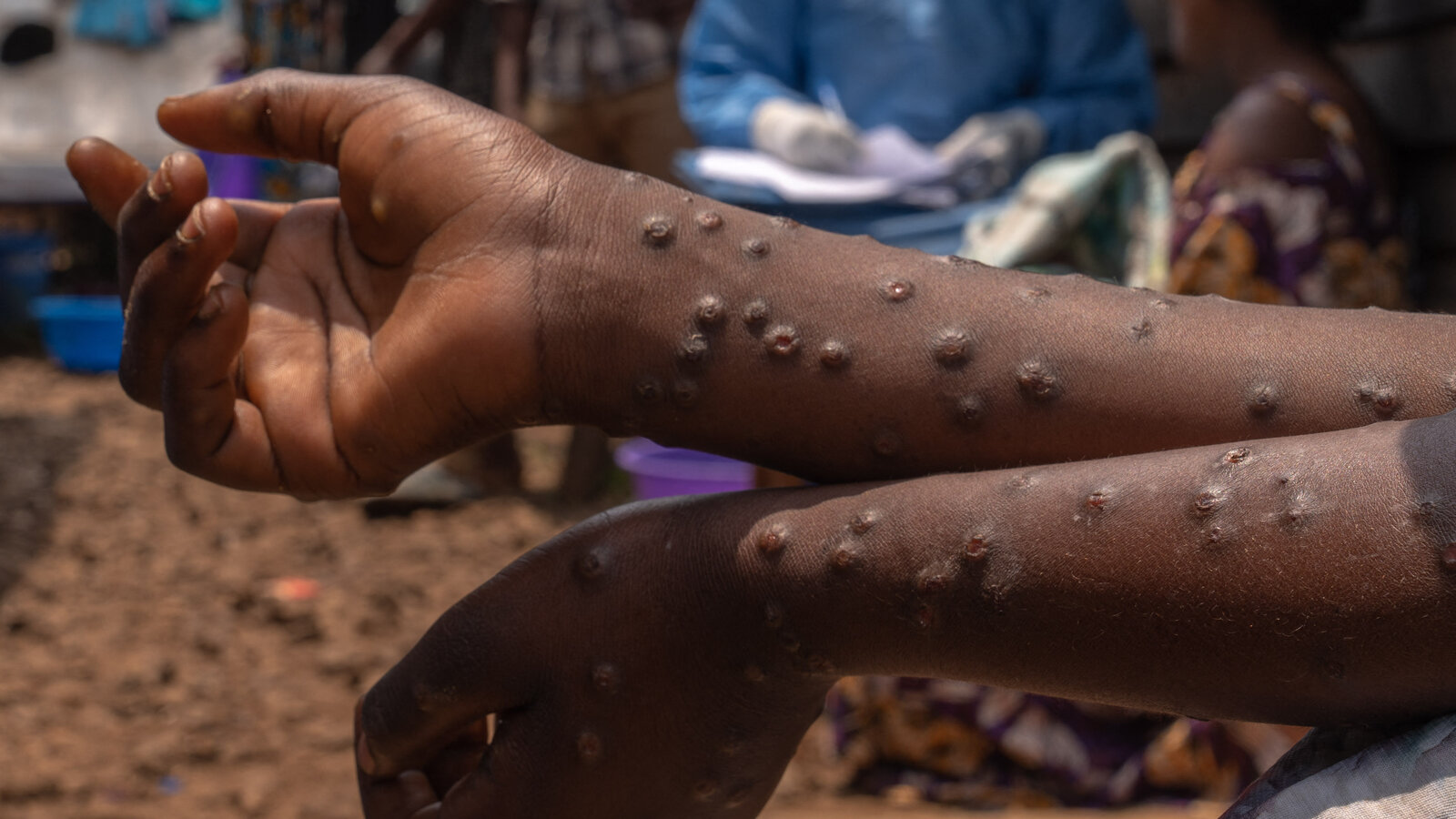 Understanding Mpox: What You Need to Know - St Joseph Health Centre